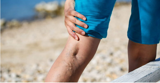  علاج الدوالي و علاج دوالى الساقين نهائيا الدوالي من أكثر المشكلات شيوعًا التي تصيب الأوعية الدموية 